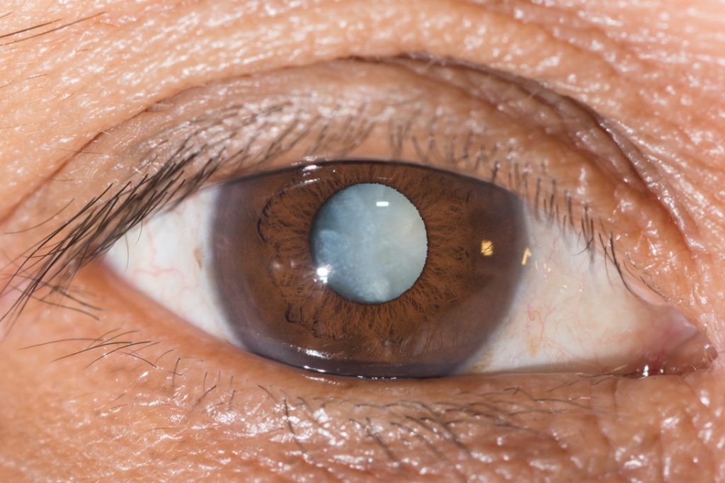 What is Secondary Cataract?